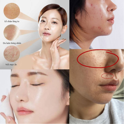 Hình ảnh làn da dầu