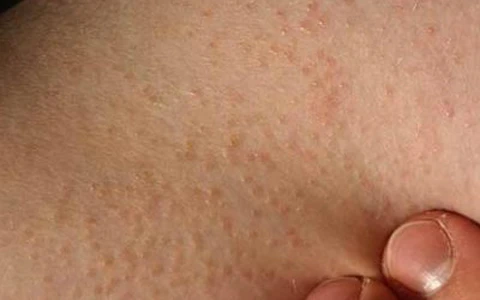 Dấu hiệu bị viêm nang lông 